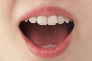 埋没法の失敗を防ぐ完全ガイド｜最新2026年の対策とおすすめクリニック紹介